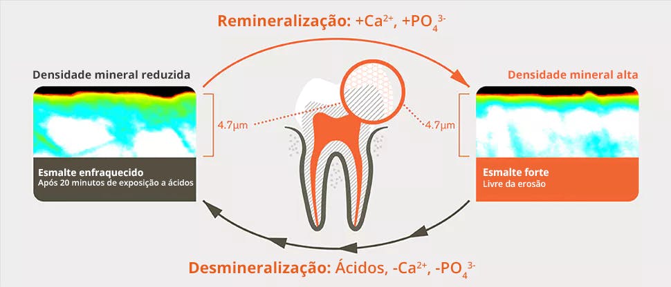 Causas da Erosão do Esmalte nos pacientes | Haleon HealthPartner